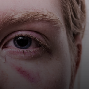 멍든 곳에 호랑이연고 함부로 바르면 안 되는 이유